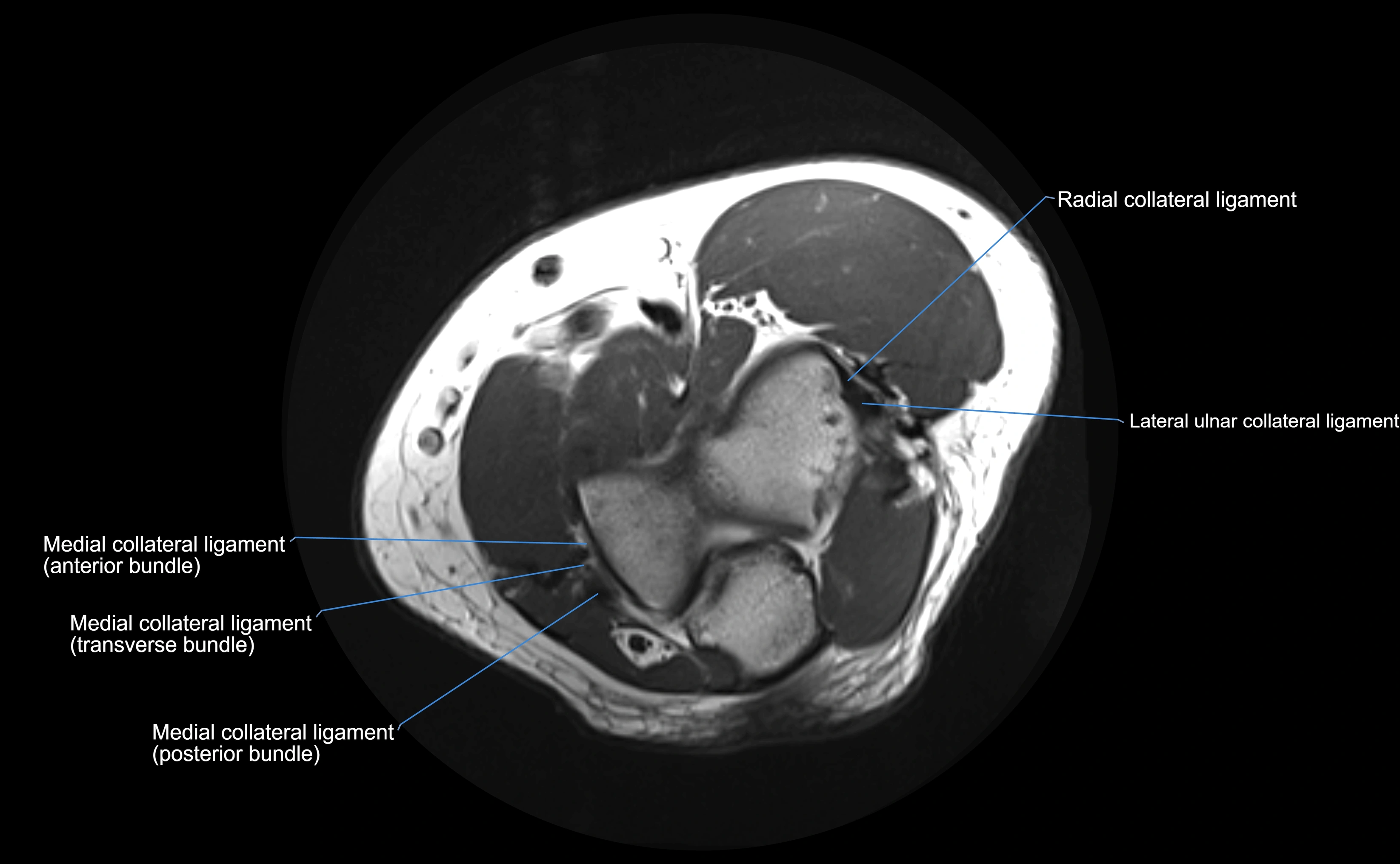 MRI elbow ligaments axial cross sectional anatomy 3T  radiology  image-img-00001-00015.webp